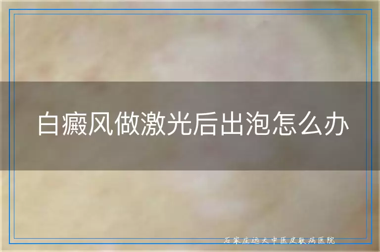 白癜风做激光后出泡怎么办