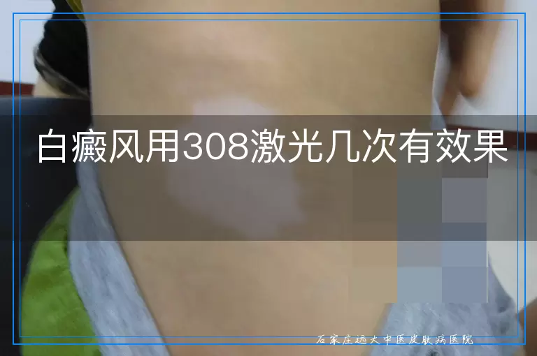 白癜风用308激光几次有效果