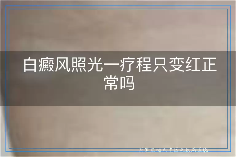 白癜风照光一疗程只变红正常吗