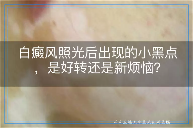 白癜风照光后出现的小黑点，是好转还是新烦恼？