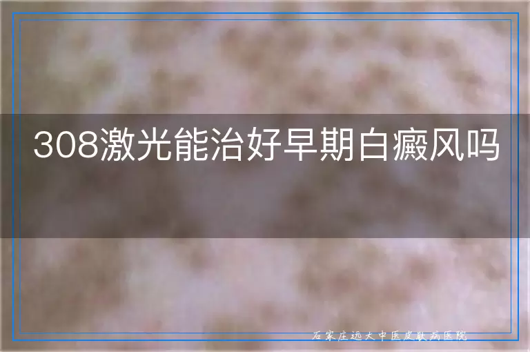 308激光能治好早期白癜风吗