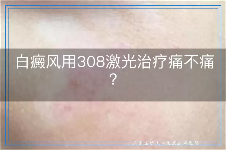 白癜风用308激光治疗痛不痛？