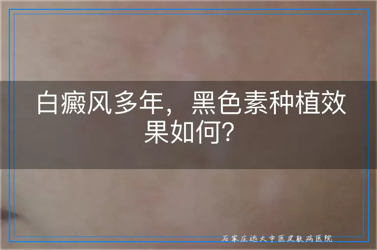 白癜风多年，黑色素种植效果如何？