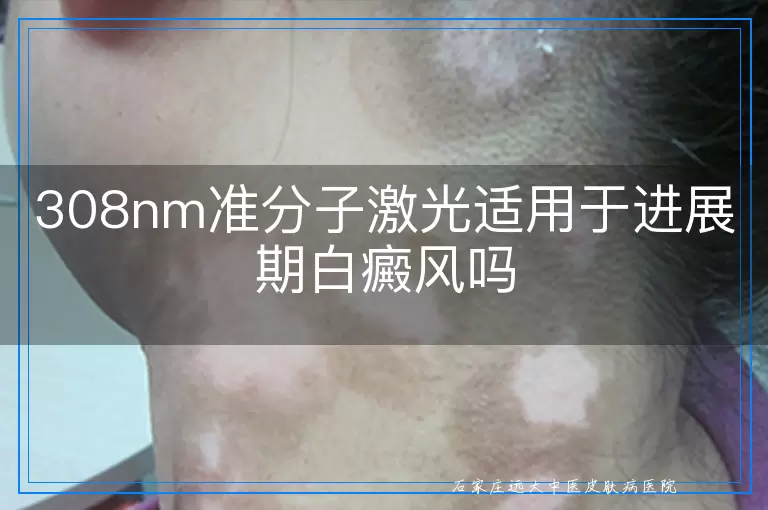 308nm准分子激光适用于进展期白癜风吗