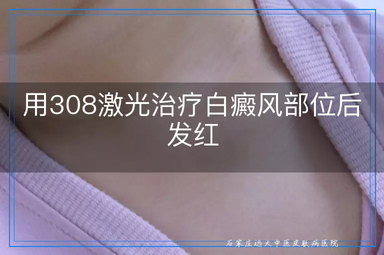 用308激光治疗白癜风部位后发红