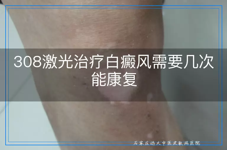308激光治疗白癜风需要几次能康复