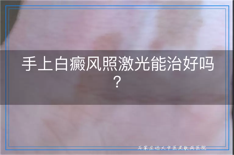 手上白癜风照激光能治好吗？