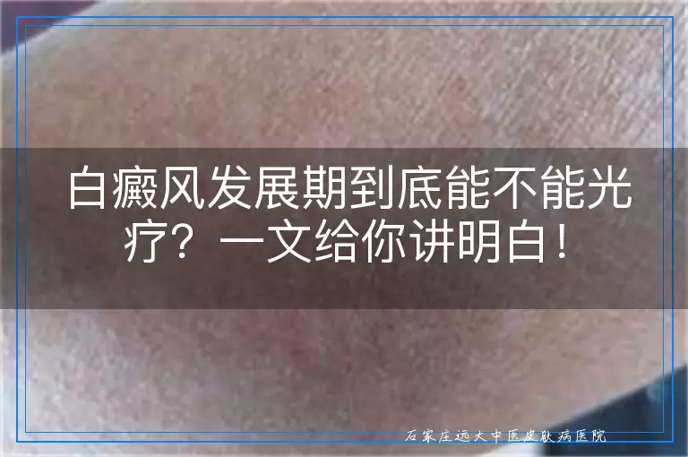 白癜风发展期到底能不能光疗？一文给你讲明白！