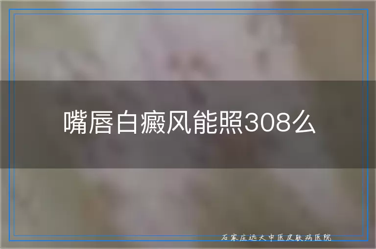嘴唇白癜风能照308么