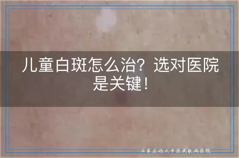 儿童白斑怎么治？选对医院是关键！