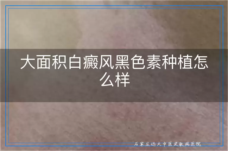大面积白癜风黑色素种植怎么样