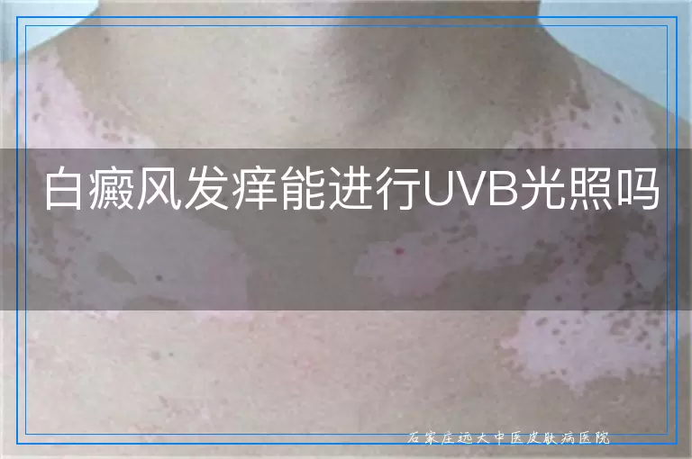 白癜风发痒能进行UVB光照吗