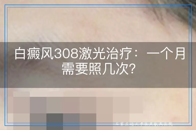 白癜风308激光治疗：一个月需要照几次？
