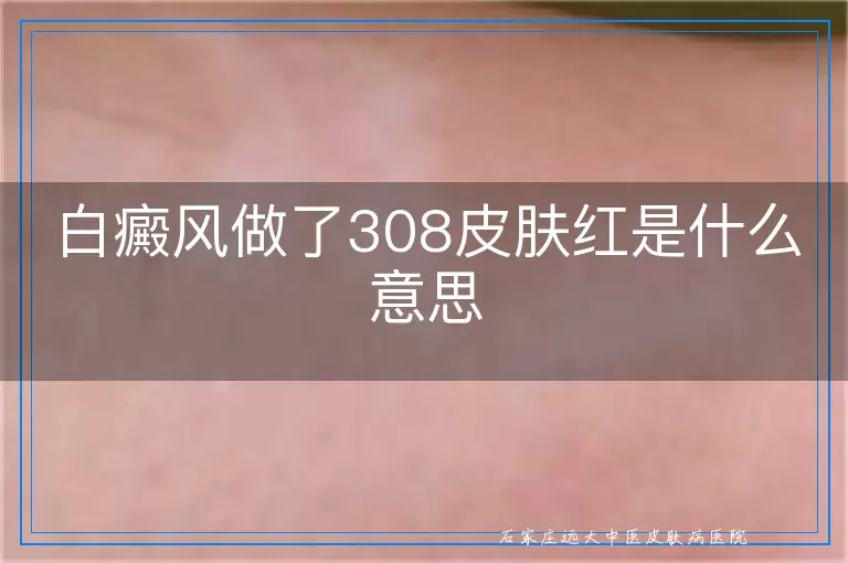 白癜风做了308皮肤红是什么意思