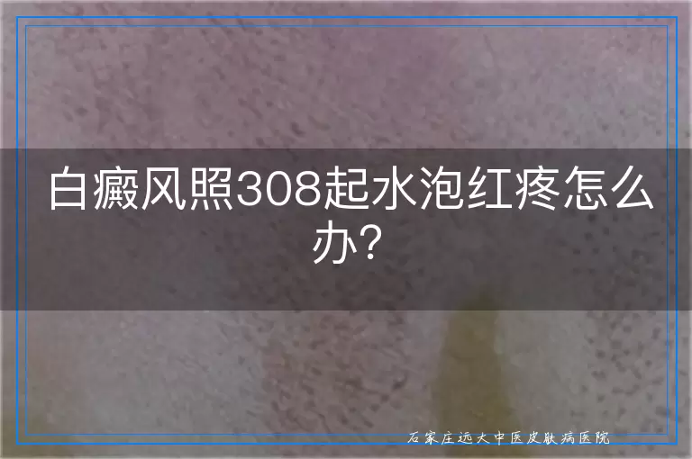 白癜风照308起水泡红疼怎么办？
