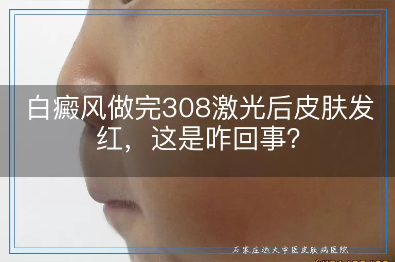 白癜风做完308激光后皮肤发红，这是咋回事？