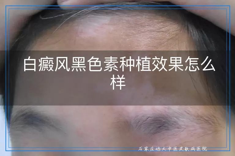 白癜风黑色素种植效果怎么样