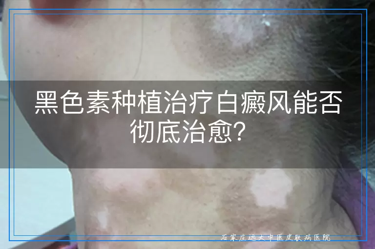 黑色素种植治疗白癜风能否彻底治愈？