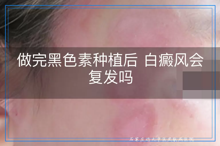 做完黑色素种植后 白癜风会复发吗