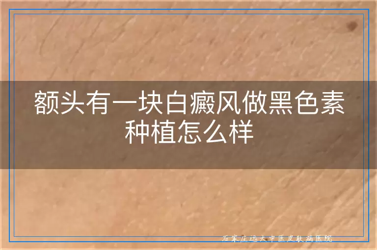 额头有一块白癜风做黑色素种植怎么样