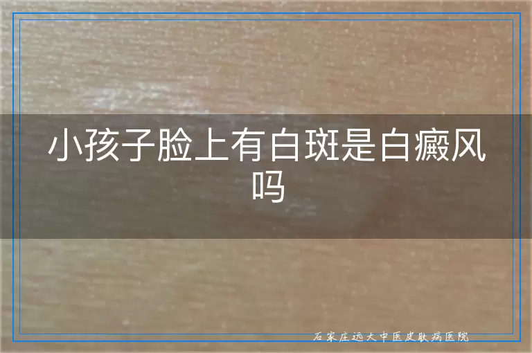 小孩子脸上有白斑是白癜风吗
