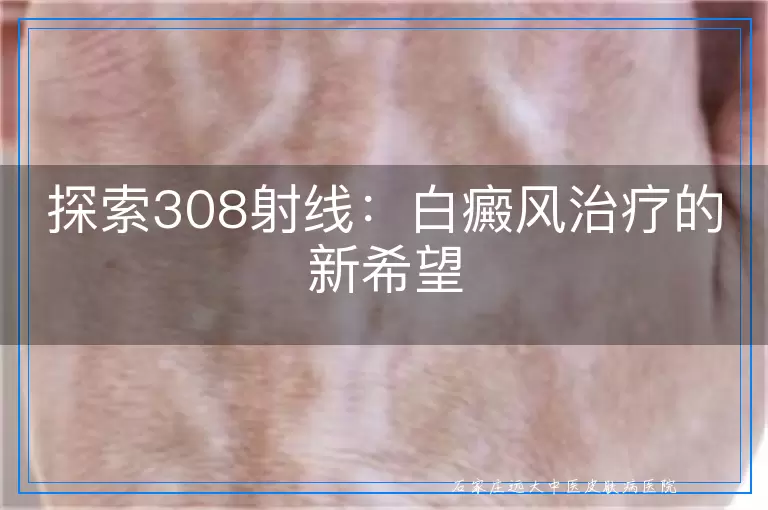 探索308射线：白癜风治疗的新希望