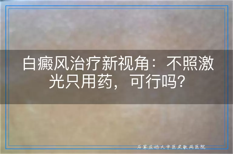 白癜风治疗新视角：不照激光只用药，可行吗？