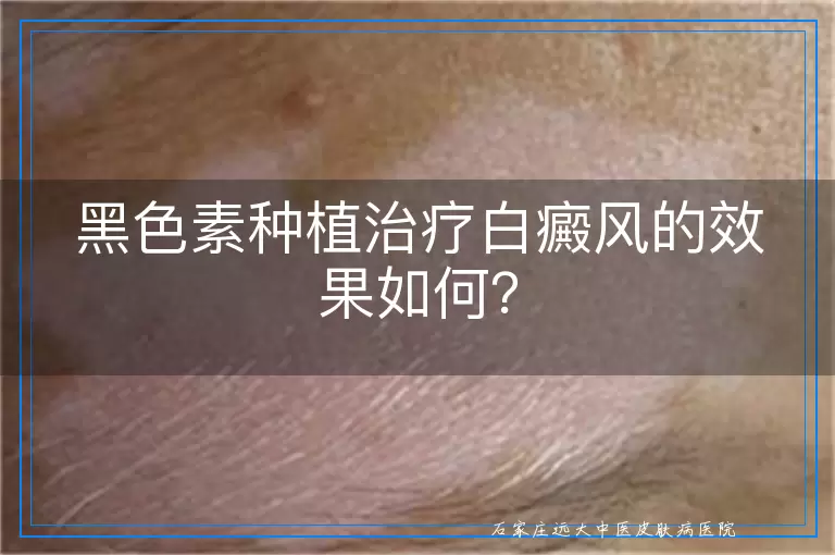 黑色素种植治疗白癜风的效果如何？