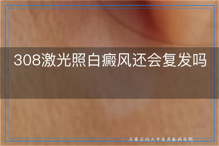 308激光照白癜风还会复发吗