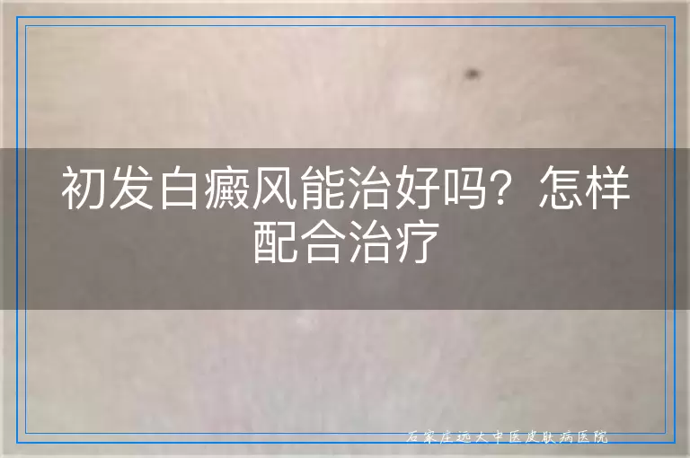 初发白癜风能治好吗？怎样配合治疗