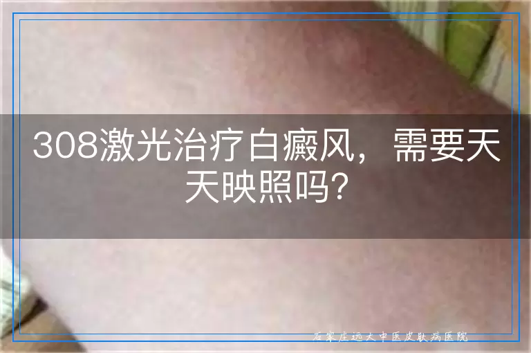308激光治疗白癜风，需要天天映照吗？