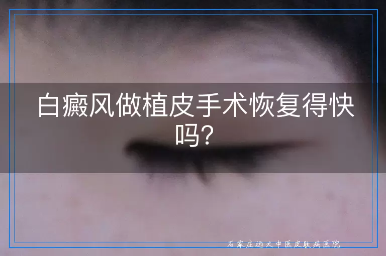 白癜风做植皮手术恢复得快吗？