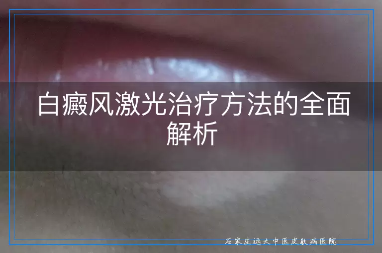 白癜风激光治疗方法的全面解析