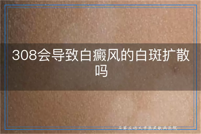 308会导致白癜风的白斑扩散吗