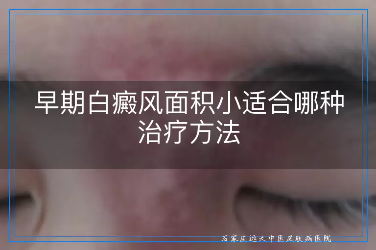 早期白癜风面积小适合哪种治疗方法