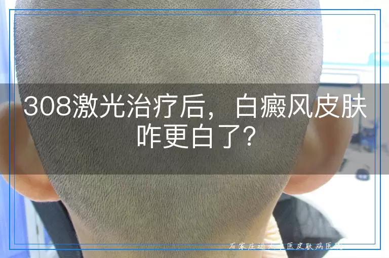 308激光治疗后，白癜风皮肤咋更白了？