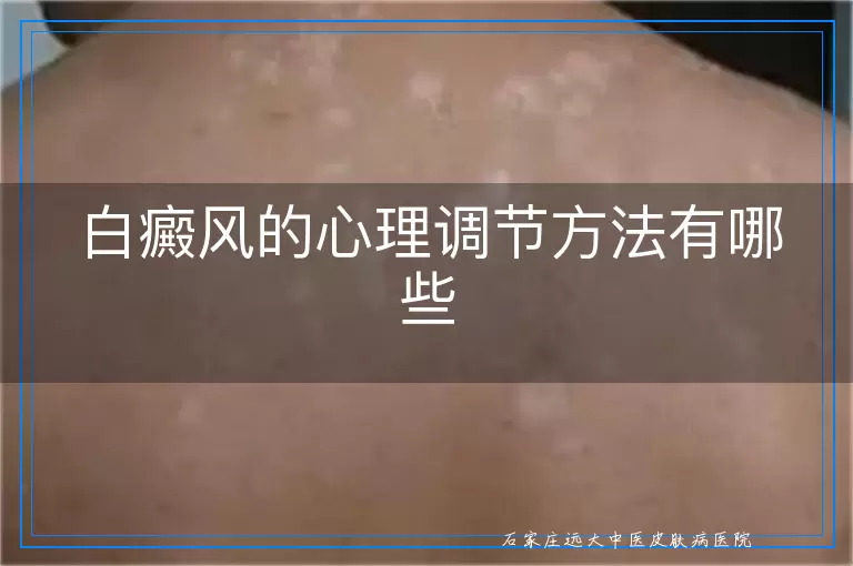 白癜风的心理调节方法有哪些