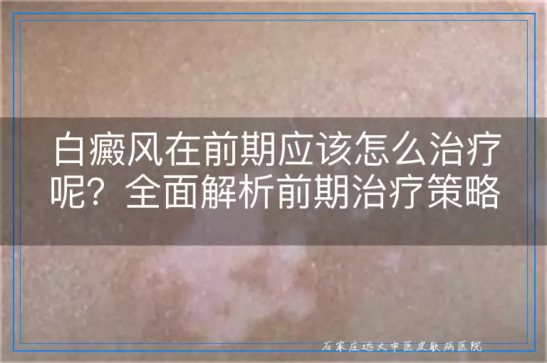 白癜风在前期应该怎么治疗呢？全面解析前期治疗策略！