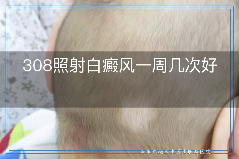 308照射白癜风一周几次好