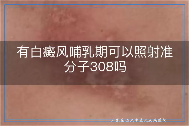 有白癜风哺乳期可以照射准分子308吗
