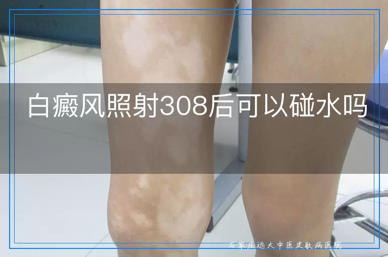 白癜风照射308后可以碰水吗