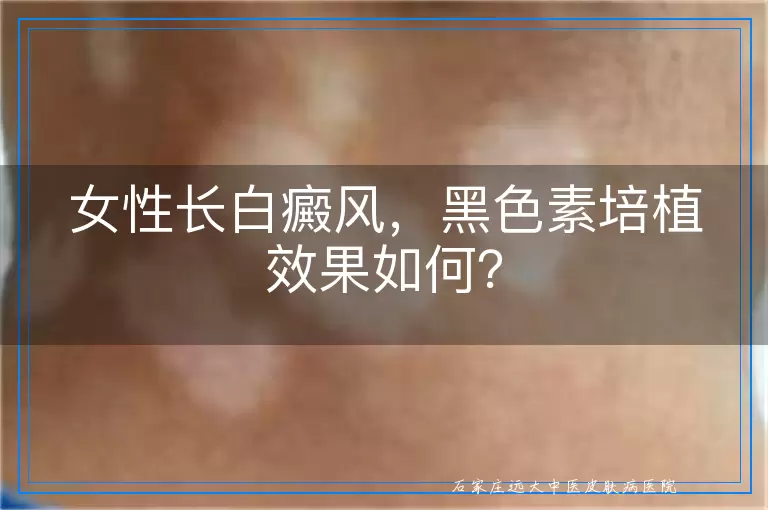 女性长白癜风，黑色素培植效果如何？