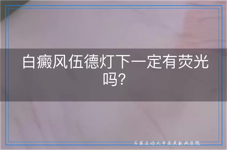 白癜风伍德灯下一定有荧光吗？