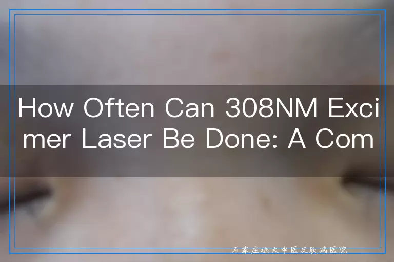 How Often Can 308NM Excimer Laser Be Done: A Comprehensive Guide