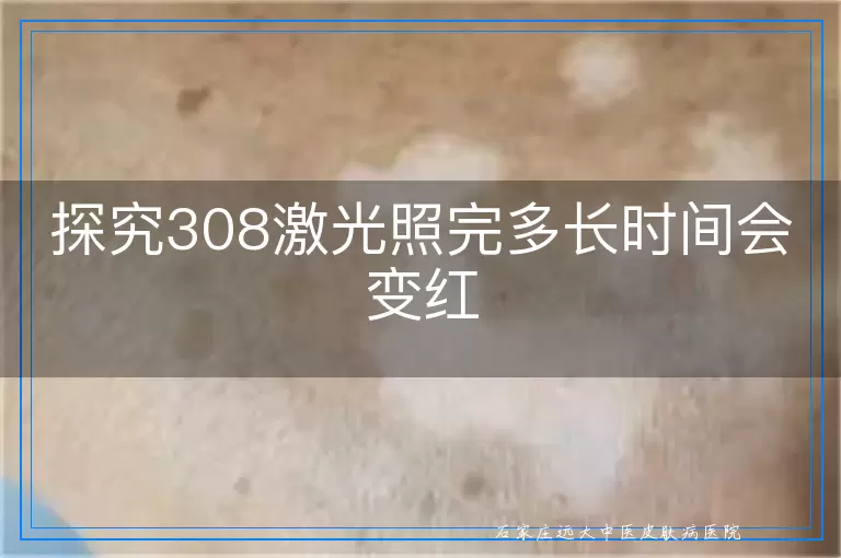 探究308激光照完多长时间会变红
