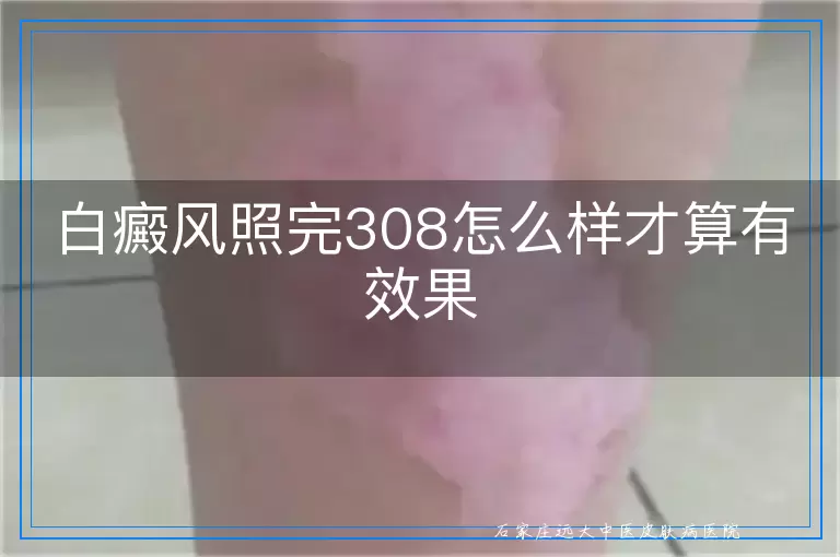 白癜风照完308怎么样才算有效果