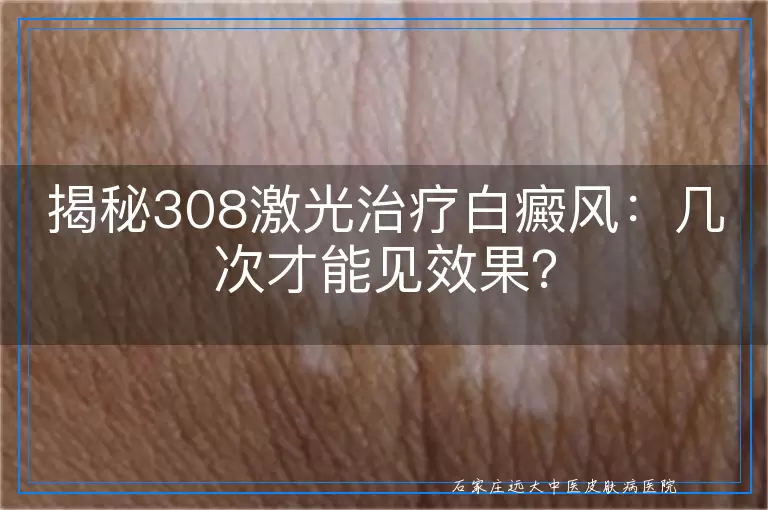 揭秘308激光治疗白癜风：几次才能见效果？