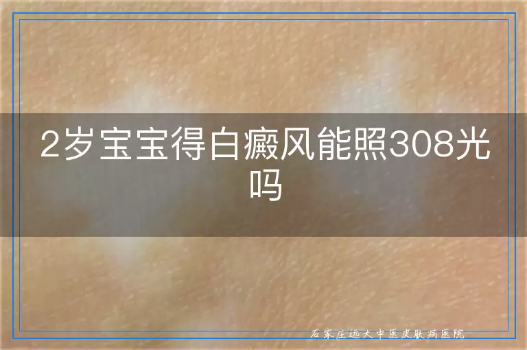 2岁宝宝得白癜风能照308光吗