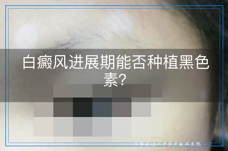白癜风进展期能否种植黑色素？