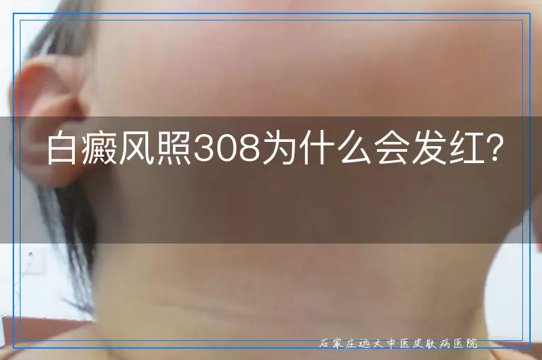白癜风照308为什么会发红？